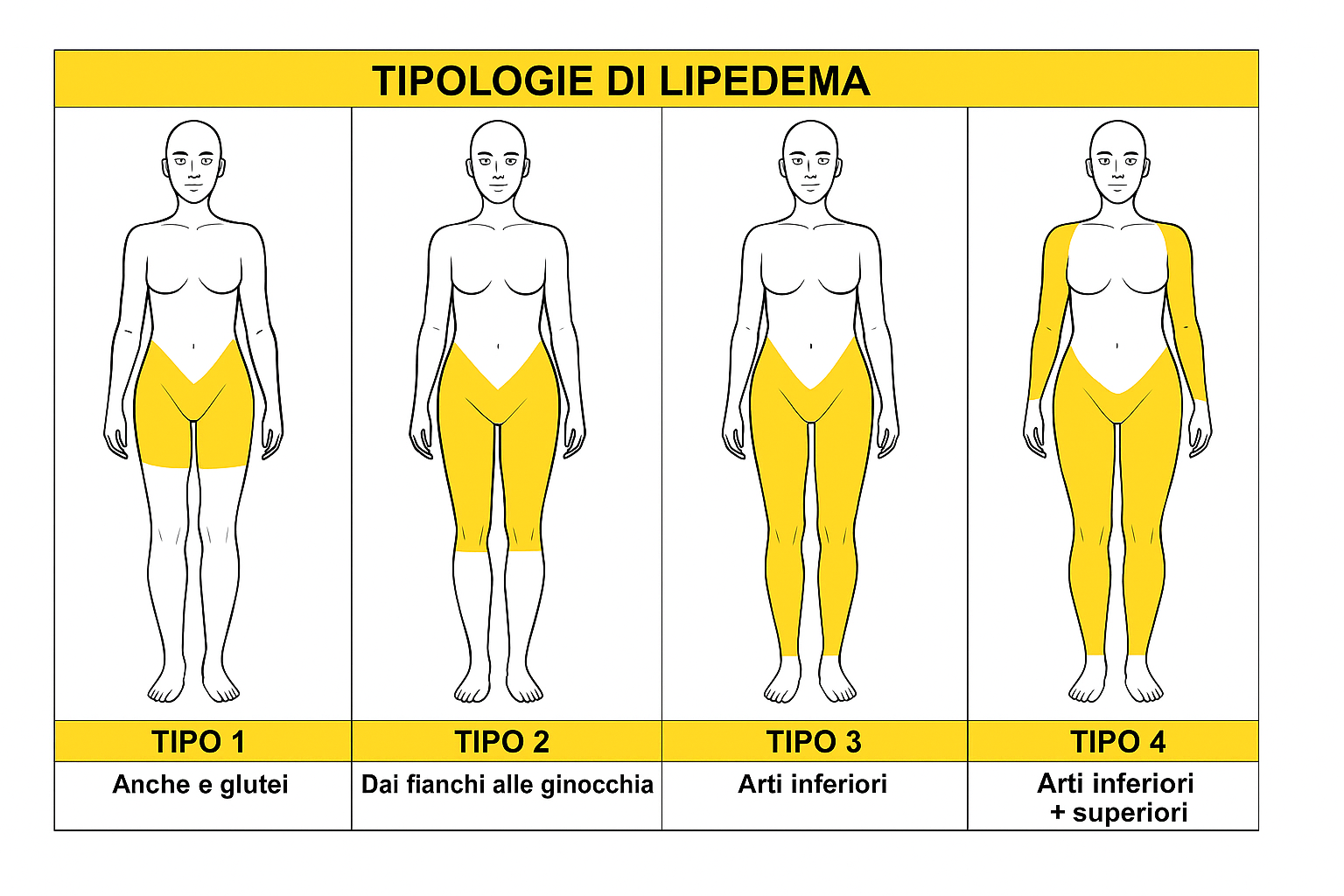 LIPEDEMA: COS’È, COME RICONOSCERLO E COME GESTIRLO
